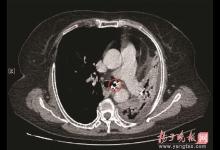 阿姨咳嗽十幾年,把左肺咳“沒”了? “元兇”竟是顆假牙