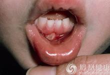 老太太因口腔潰瘍被割舌頭?兩周不愈當心是癌!