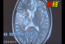 少女大腦皮層萎縮 醫(yī)生從她腦子里捉出5cm長(zhǎng)蟲(chóng)子