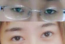 實地探訪暑期整容熱潮，為什么母親要求我整容？