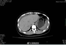 半年沒見老公太生猛,激情后她流了全身近40%的血…