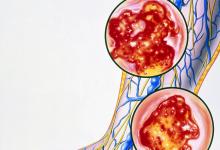 新研究表明:靜脈曲張與血栓發作幾率增高有關