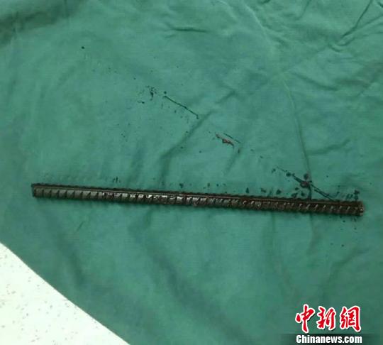 一米余長鋼筋穿破工人腹部 醫生消防協力挽回生命