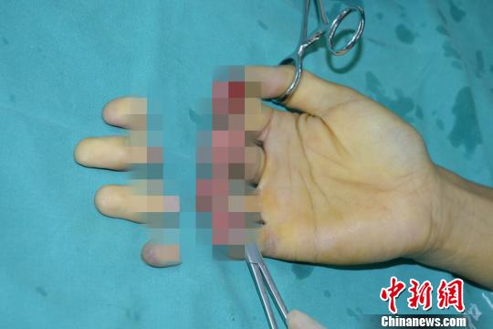 男子突發意外七根手指被壓斷 醫生順利接上