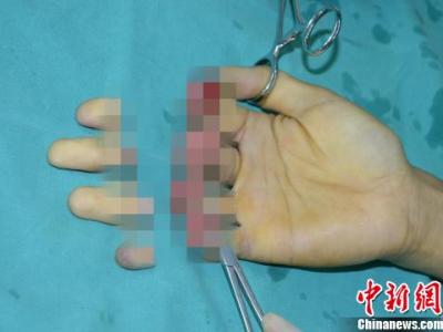 男子突發意外七根手指被壓斷 醫生順利接上