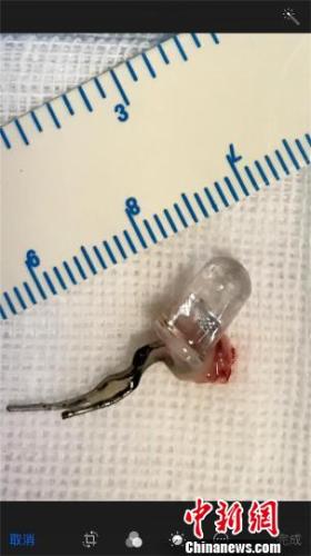 男孩誤吞LED發光二極管 深入支氣管險些扎破肺