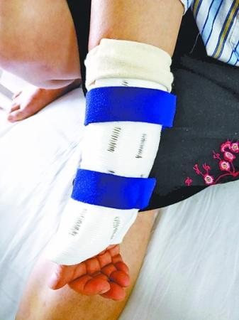 武漢首個(gè)玉米淀粉3D打印支具“上手”-易網(wǎng)<a href=http://www.jsjjzhkt.cn/ target=_blank class=infotextkey>健康養(yǎng)生</a>網(wǎng) 武漢首個(gè)玉米淀粉3D打印支具“上手”