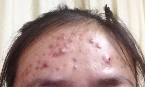 金華祛痘醫院?義烏歐萊美邀你免費祛痘啦-易網健康養生網 金華祛痘醫院?義烏歐萊美邀你免費祛痘啦