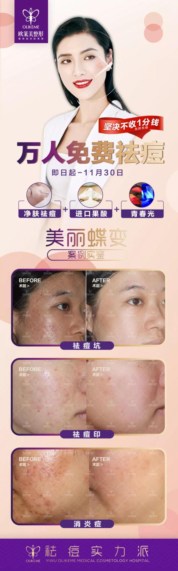 金華祛痘醫院?義烏歐萊美邀你免費祛痘啦-易網健康養生網 金華祛痘醫院?義烏歐萊美邀你免費祛痘啦