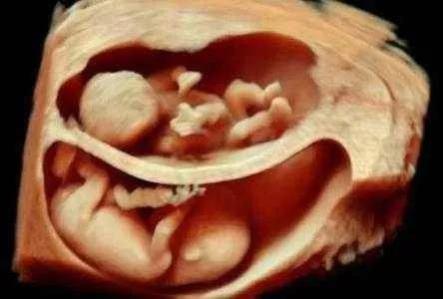 懷了雙胞胎又驚喜又擔憂,唐山寶島婦兒醫院為您保駕護航-易網健康<a href=http://www.jsjjzhkt.cn/jkys/ target=_blank class=infotextkey>養生</a>網 懷了雙胞胎又驚喜又擔憂,唐山寶島婦兒醫院為您保駕護航