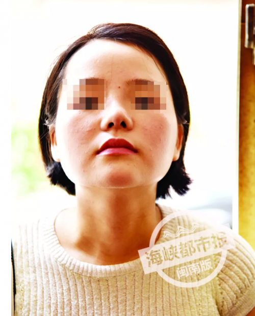 泉州東大整形醫(yī)院被投訴:女子花4.4萬整容 鼻子歪成這樣-易網(wǎng)健康<a href=http://www.jsjjzhkt.cn/jkys/ target=_blank class=infotextkey>養(yǎng)生</a>網(wǎng) 泉州東大整形醫(yī)院被投訴:女子花4.4萬整容 鼻子歪成這樣