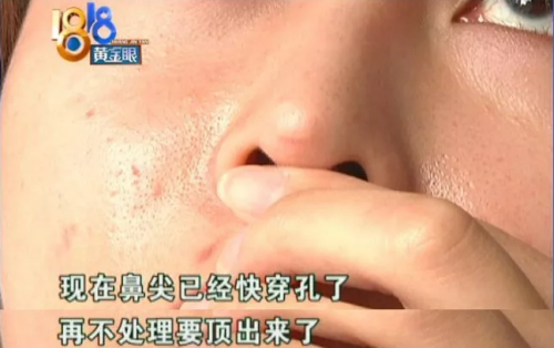 杭州麗星整形醫院整壞了鼻子至妍醫療美容來修復 醫院更名了?-易網<a href=http://www.jsjjzhkt.cn/ target=_blank class=infotextkey>健康養生</a>網 杭州麗星整形醫院整壞了鼻子至妍醫療美容來修復 醫院更名了?