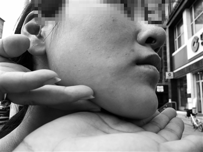 沈陽(yáng)茗湲醫(yī)療美容整容失敗 25歲女孩鼻子填充物外露不敢出門見人-易網(wǎng)健康<a href=http://www.jsjjzhkt.cn/jkys/ target=_blank class=infotextkey>養(yǎng)生</a>網(wǎng) 沈陽(yáng)茗湲醫(yī)療美容整容失敗 25歲女孩鼻子填充物外露不敢出門見人