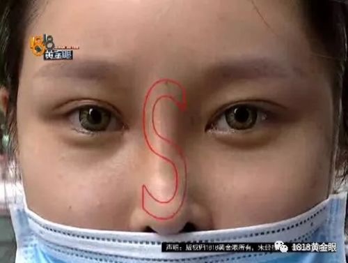 三女子整容均出現不同程度歪斜 義烏陽光美容醫院：本身就有問題