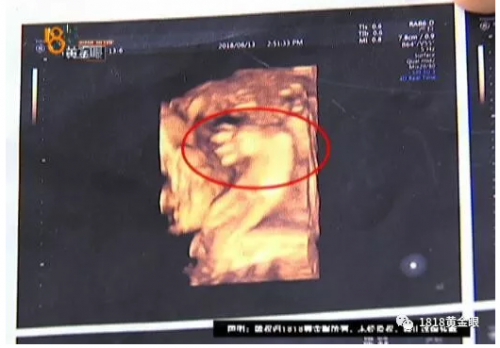 杭州余杭婦產醫(yī)院沒查出胎兒雙手畸形要不要擔責?B超能查胎兒畸形嗎?-易網健康養(yǎng)生網 杭州余杭婦產醫(yī)院沒查出胎兒雙手畸形要不要擔責?B超能查胎兒畸形嗎?