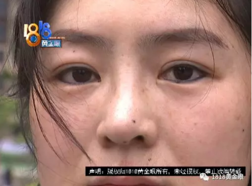 寧波童顏美容整形醫院整形失敗了?女子:被毀容了-易網<a href=http://www.jsjjzhkt.cn/ target=_blank class=infotextkey>健康養生</a>網 寧波童顏美容整形醫院整形失敗了?女子:被毀容了