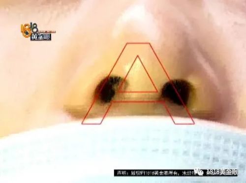 三女子整容均出現不同程度歪斜 義烏陽光美容醫院：本身就有問題