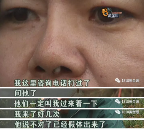 六年前在寧波珈禾整形專科醫院做隆鼻 現在鼻子不舒服露出白色假體-易網<a href=http://www.jsjjzhkt.cn/ target=_blank class=infotextkey>健康養生</a>網 六年前在寧波珈禾整形專科醫院做隆鼻 現在鼻子不舒服露出白色假體