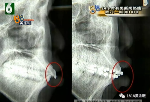 花1.3萬在寧波壹加壹美容醫院整形 姑娘：嘴巴外凸并沒改善