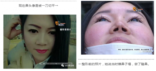 動了三次刀 患者:湖州曙光醫療美容醫院把我鼻子做的跟豬一樣-易網<a href=http://www.jsjjzhkt.cn/ target=_blank class=infotextkey>健康養生</a>網 動了三次刀 患者:湖州曙光醫療美容醫院把我鼻子做的跟豬一樣