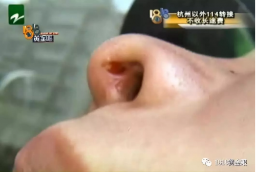 女子在寧波尚美整形醫院整形失敗 手術效果差傷口還化膿-易網<a href=http://www.jsjjzhkt.cn/ target=_blank class=infotextkey>健康養生</a>網 女子在寧波尚美整形醫院整形失敗 手術效果差傷口還化膿