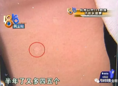 患者在杭州麗都白癜風醫院花冤枉錢?原本只需200元卻花了近六千-易網<a href=http://www.jsjjzhkt.cn/ target=_blank class=infotextkey>健康養生</a>網 患者在杭州麗都白癜風醫院花冤枉錢?原本只需200元卻花了近六千