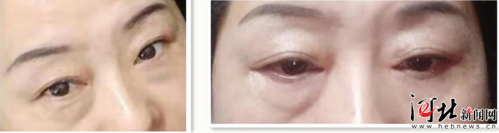 河北一女子在石家莊萬瑞醫療整形后眼睛閉不緊 醫院:不滿意可二次修復-易網健康<a href=http://www.jsjjzhkt.cn/jkys/ target=_blank class=infotextkey>養生</a>網 河北一女子在石家莊萬瑞醫療整形后眼睛閉不緊 醫院:不滿意可二次修復