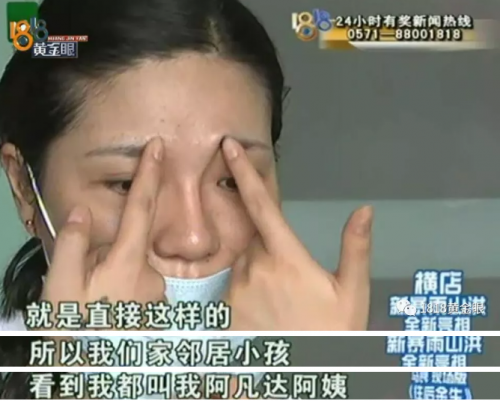 女子在紹興華美整形醫院整形后眼睛有異物感 鼻子也被整成像阿凡達-易網<a href=http://www.jsjjzhkt.cn/ target=_blank class=infotextkey>健康養生</a>網 女子在紹興華美整形醫院整形后眼睛有異物感 鼻子也被整成像阿凡達