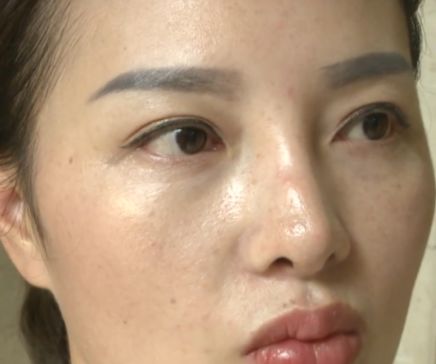 杭州美萊美容醫(yī)院把我鼻子做壞了 高價隆鼻后凹凸不平