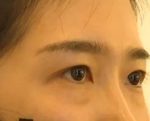 女子在杭州珈禾整形美容醫(yī)院打熊貓針結(jié)果變成熊貓眼？