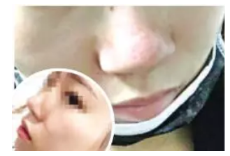 泉州逸膚中醫(yī)皮膚病醫(yī)院激光祛痘坑失敗 院方:已辦理退款-易網(wǎng)健康<a href=http://www.jsjjzhkt.cn/jkys/ target=_blank class=infotextkey>養(yǎng)生</a>網(wǎng) 泉州逸膚中醫(yī)皮膚病醫(yī)院激光祛痘坑失敗 院方:已辦理退款