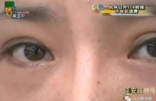 女子在紹興華美整形醫院整形后眼睛有異物感 鼻子也被整成像阿凡達-易網健康養生網 女子在紹興華美整形醫院整形后眼睛有異物感 鼻子也被整成像阿凡達