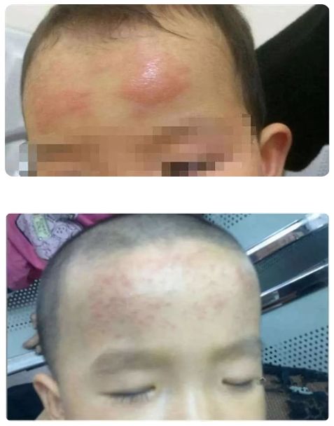 網(wǎng)紅退熱貼真這么神奇嗎?只能物理降溫 有的孩子出現(xiàn)過敏表現(xiàn)-易網(wǎng)<a href=http://www.jsjjzhkt.cn/ target=_blank class=infotextkey>健康養(yǎng)生</a>網(wǎng) 網(wǎng)紅退熱貼真這么神奇嗎?只能物理降溫 有的孩子出現(xiàn)過敏表現(xiàn)