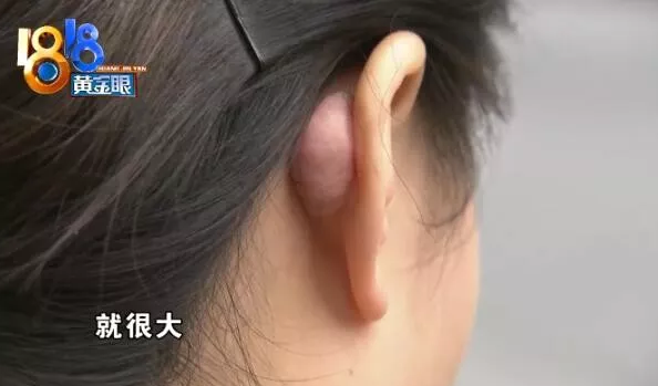 杭州千晴整形醫院隆鼻后耳后根長了個包 鼻孔也一大一小-易網健康<a href=http://www.jsjjzhkt.cn/jkys/ target=_blank class=infotextkey>養生</a>網 杭州千晴整形醫院隆鼻后耳后根長了個包 鼻孔也一大一小