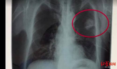 玉佩致胸片陰影誤診?四川勞研科技有限公司體檢顯示正常 男子一年后去世-易網(wǎng)健康<a href=http://www.jsjjzhkt.cn/jkys/ target=_blank class=infotextkey>養(yǎng)生</a>網(wǎng) 玉佩致胸片陰影誤診?四川勞研科技有限公司體檢顯示正常 男子一年后去世