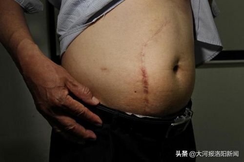 13年前只在洛陽市商業職工醫院做過一次闌尾手術 為何膽囊不見了?-易網健康<a href=http://www.jsjjzhkt.cn/jkys/ target=_blank class=infotextkey>養生</a>網 13年前只在洛陽市商業職工醫院做過一次闌尾手術 為何膽囊不見了?