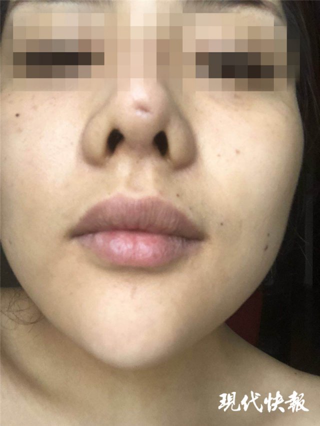 南京怡華醫(yī)療美容醫(yī)院整形失敗 90后姑娘隆鼻后成了“豬鼻子”-易網(wǎng)<a href=http://www.jsjjzhkt.cn/ target=_blank class=infotextkey>健康養(yǎng)生</a>網(wǎng) 南京怡華醫(yī)療美容醫(yī)院整形失敗 90后姑娘隆鼻后成了“豬鼻子”