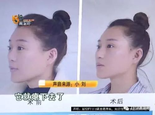 三女子整容均出現不同程度歪斜 義烏陽光美容醫院：本身就有問題