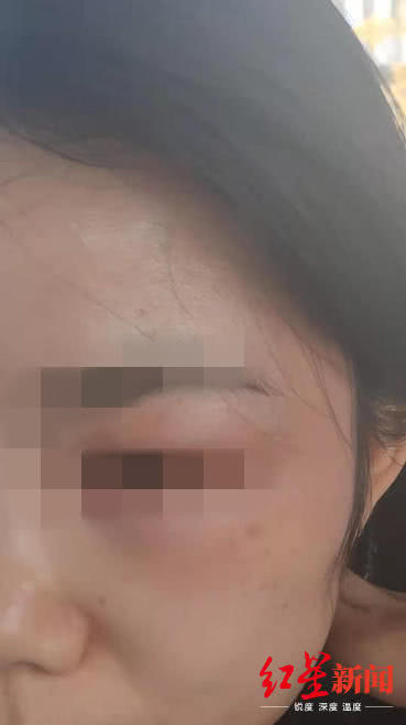 女子在宜賓韓美整形后差點毀容 醫院:個體差異-易網<a href=http://www.jsjjzhkt.cn/ target=_blank class=infotextkey>健康養生</a>網 女子在宜賓韓美整形后差點毀容 醫院:個體差異