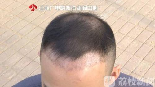 南京美貝爾整形醫院聲稱植發成活率95% 可植發一個月掉了一半