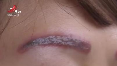 去南昌韓美美容醫(yī)院激光洗眉后生不如死 洗完感覺自己像怪物