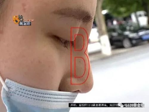 三女子整容均出現不同程度歪斜 義烏陽光美容醫院：本身就有問題