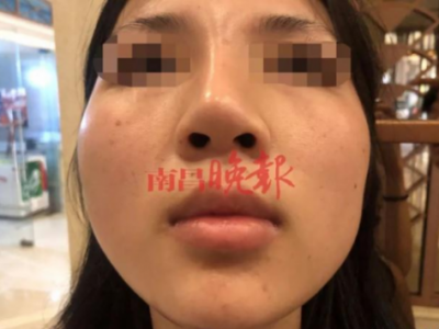南昌禾麗整形醫(yī)院把我鼻子整歪了 記者介入?yún)f(xié)調才同意免費修復