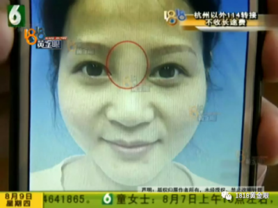 想要“柔美”結果寧波益寶醫療美容把她整像豬頭？