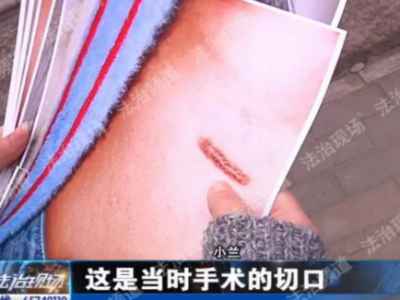 鄭州新生醫院隆鼻失敗 假體往外透院方稱沒法解決