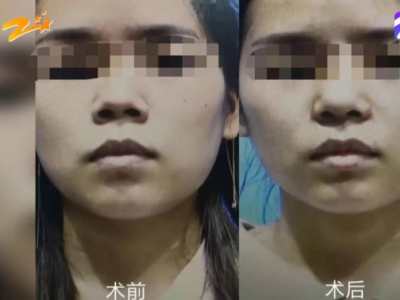 杭州甄美整形醫院把人鼻子整歪了？醫院：自己長歪了