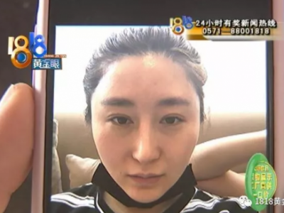 杭州華山連天美整形醫院把我鼻子做歪了 整的像阿凡達