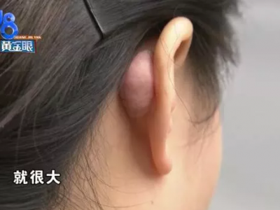 杭州千晴整形醫院隆鼻后耳后根長了個包 鼻孔也一大一小