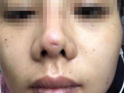 南京怡華醫療美容醫院整形失敗 90后姑娘隆鼻后成了“豬鼻子”