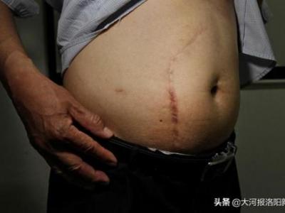 13年前只在洛陽市商業職工醫院做過一次闌尾手術 為何膽囊不見了？